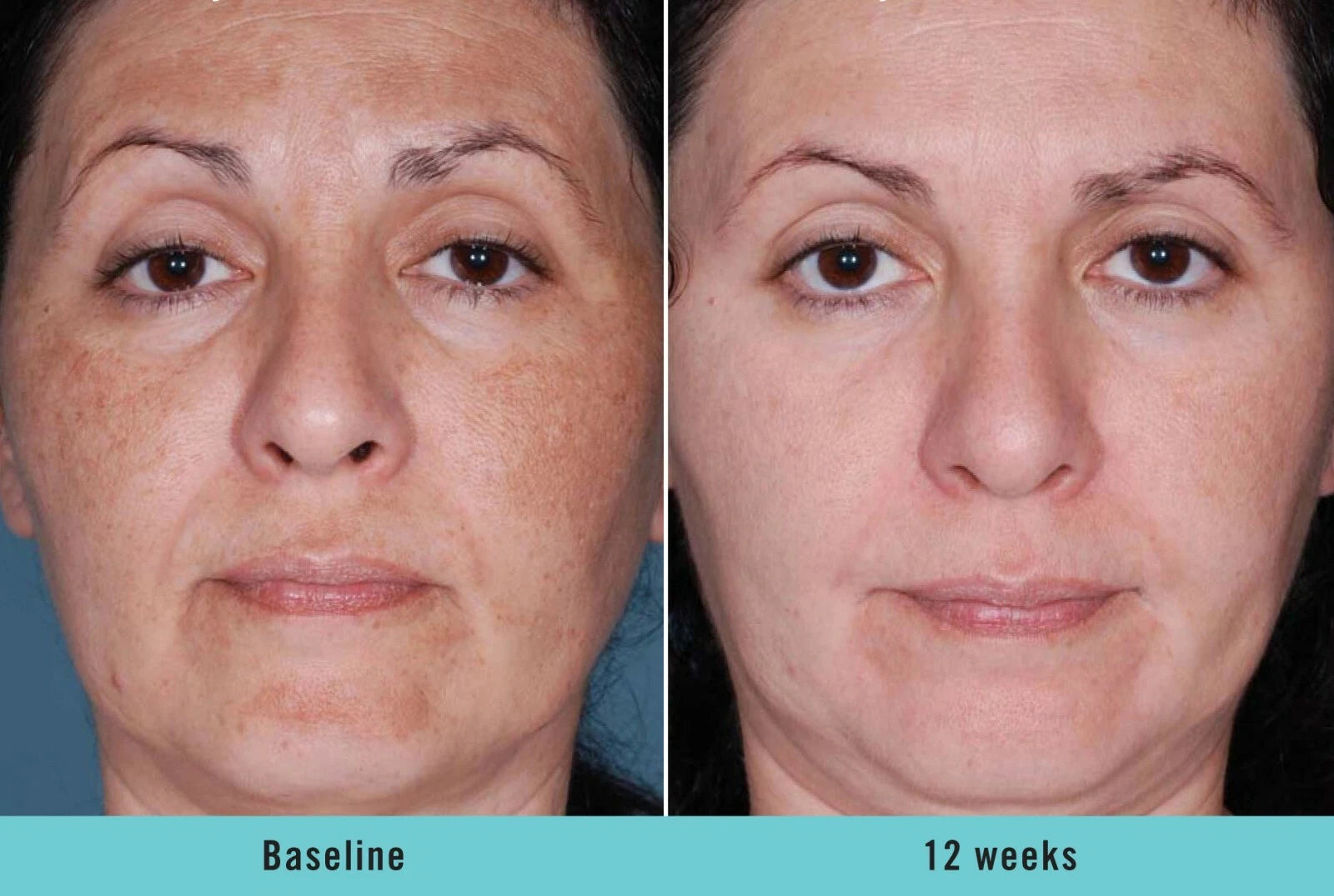Kojic Acid Brightening Serum & Dark Spot Cream