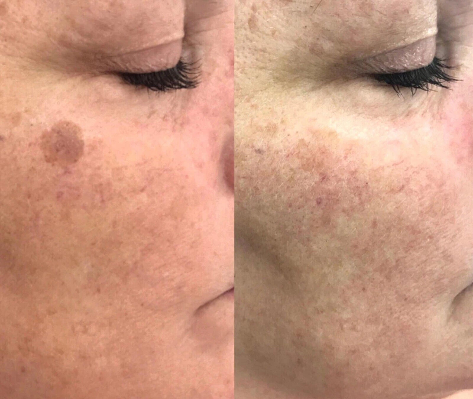 Short Title: Sun Spot & Dark Spot Corrector – Age Spot Treatment