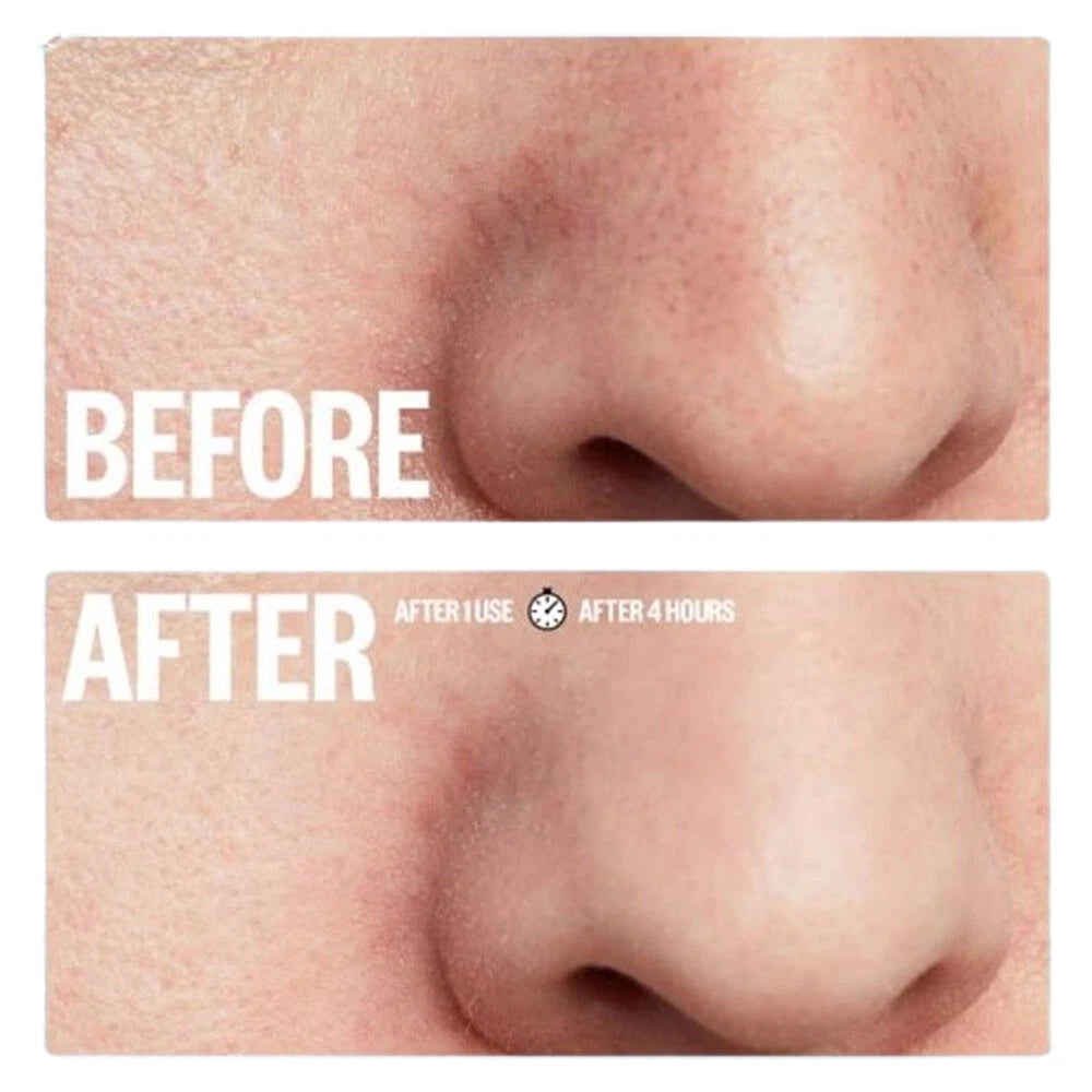 BTF Blackhead Nose Pore Strips – Deep Cleansing Blackhead Removal – 10 Strips
