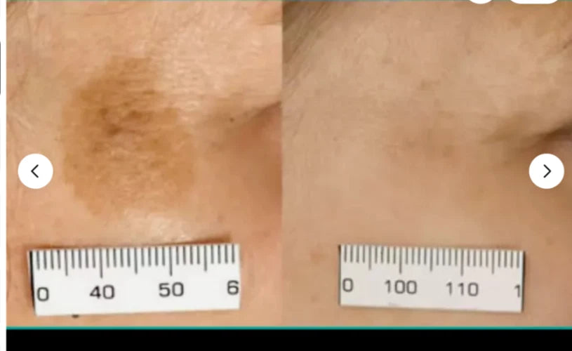 Short Title: Sun Spot & Dark Spot Corrector – Age Spot Treatment