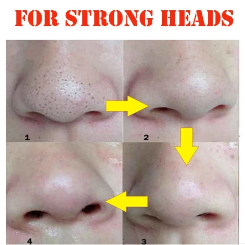 BTF Blackhead Nose Pore Strips – Deep Cleansing Blackhead Removal – 10 Strips